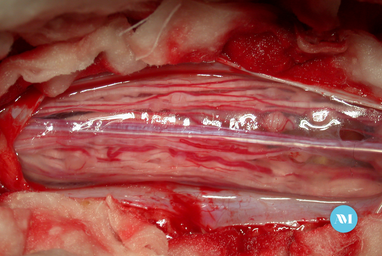 Resultado de imagen para Cirugia medular
